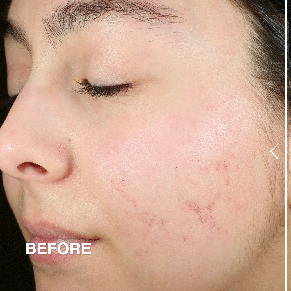 Acne Oil-Control Matte Moisturizer