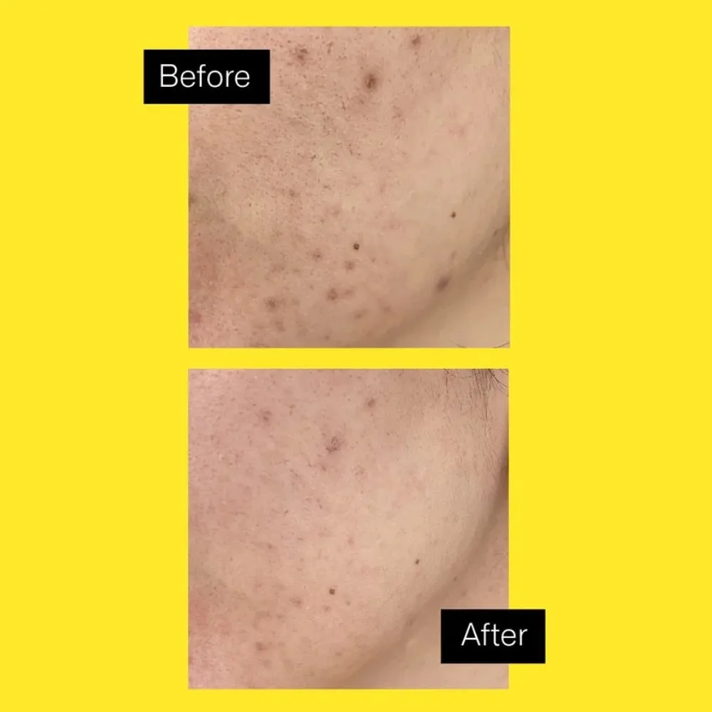 Acnemy Zitpeel 40ml