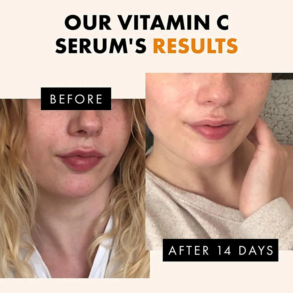 Advanced Vitamin C Glow Serum with AHA, Kojic Acid & Glutathione – 120ml Premium Skin Brightening & Anti-Aging Formula for Dark Spots, Wrinkles, and Radiant Skin