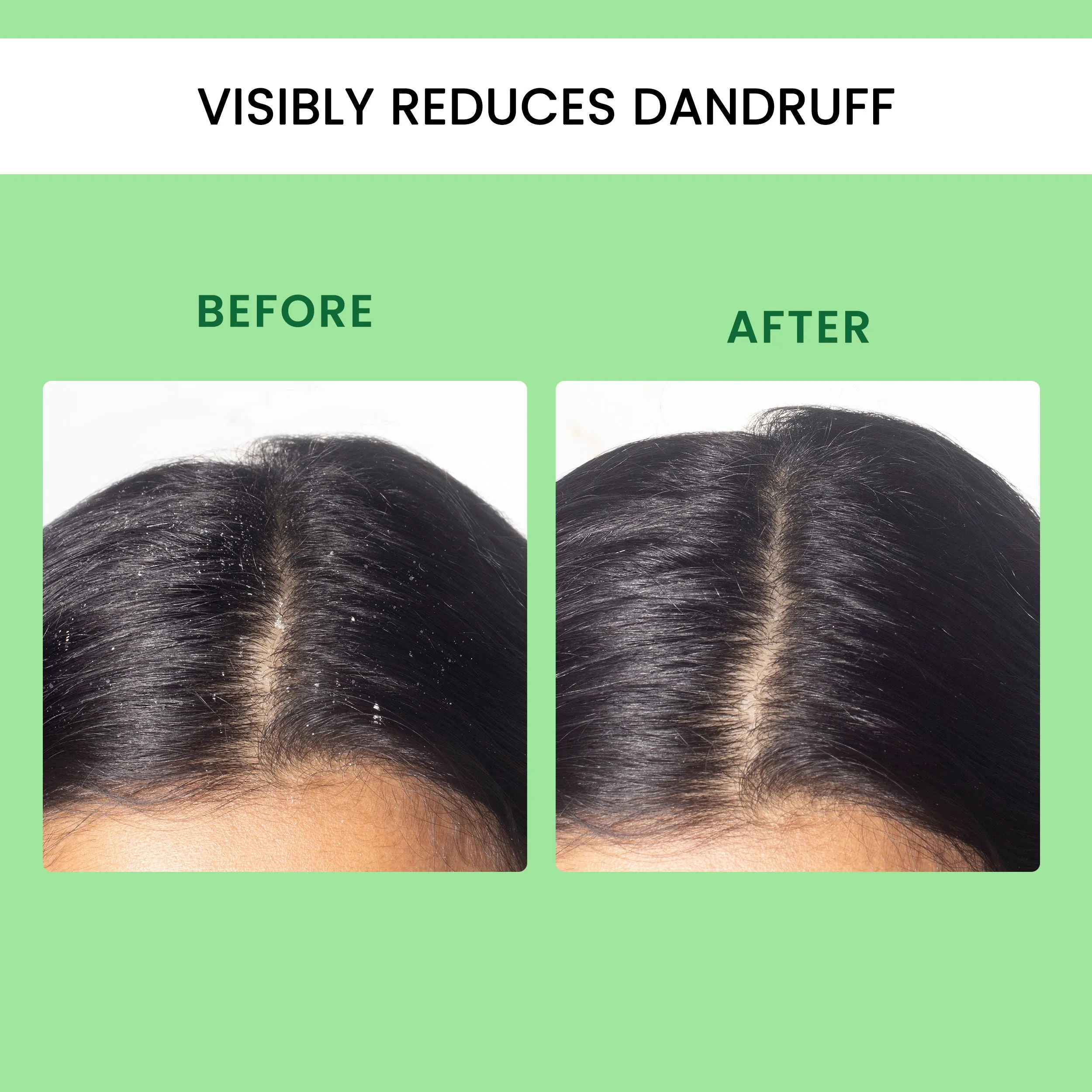Alps Goodness Tea Tree Oil, Hyaluronic Acid & Ketoconazole Anti Dandruff Scalp Serum For Oily Scalp (30 ml)