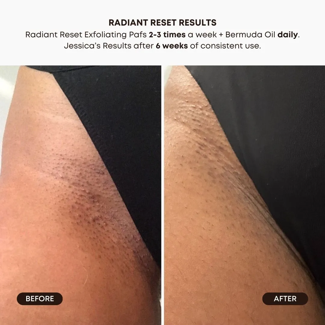 Chemical Exfoliant with TXA Exclusive Offer