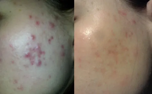 Dermaflannel® Exfoliator for Face & Body