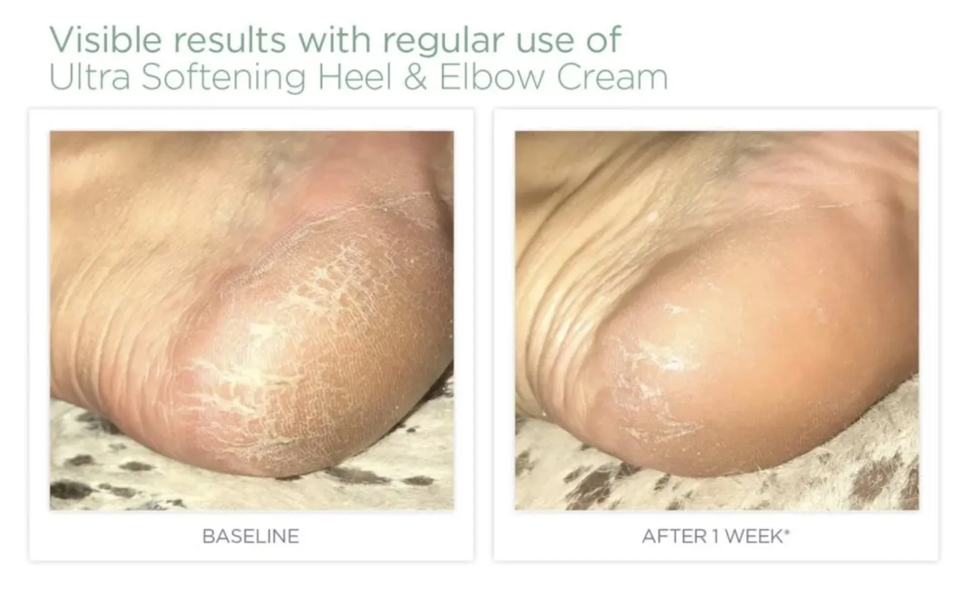 Glytone AHA  Ultra Softening Foot Cream