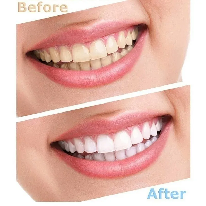 Gollo Professional Peroxide & LED Teeth Whitening Kit