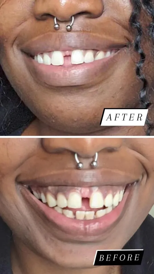 "Complete Whitening" Kit