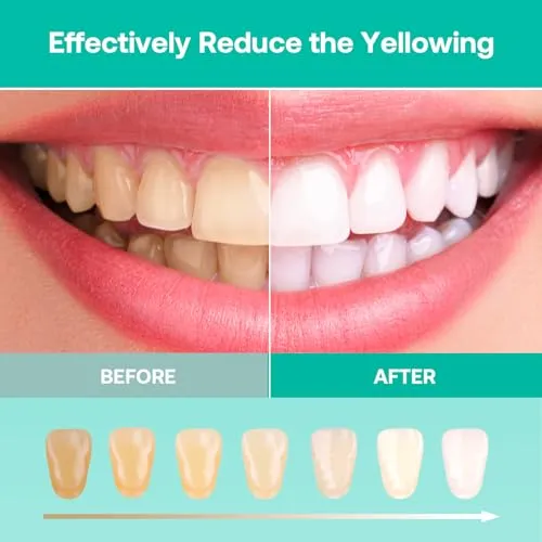 Teeth Whitening Kit, LED Teeth Whitening Light with 6 X 3ml Carbamide Peroxide Teeth Whitening Gel, Included 2 Mouth Trays & Tray Case and Brush, Safe Enamel, Fast and Gentle Teeth Whitening