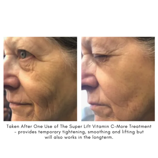 The Super Lift | Vitamin C-More Treatment