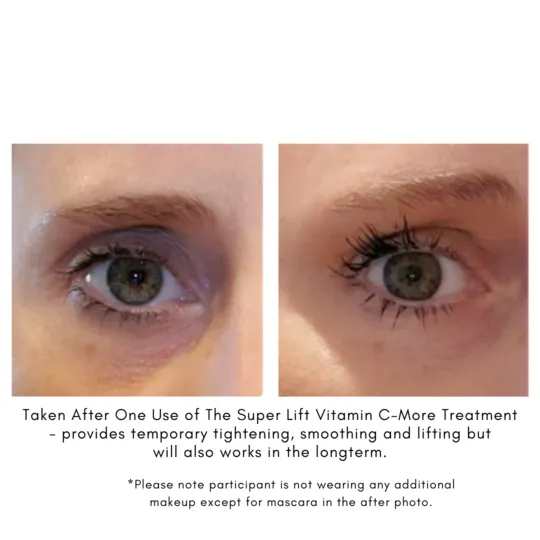 The Super Lift | Vitamin C-More Treatment