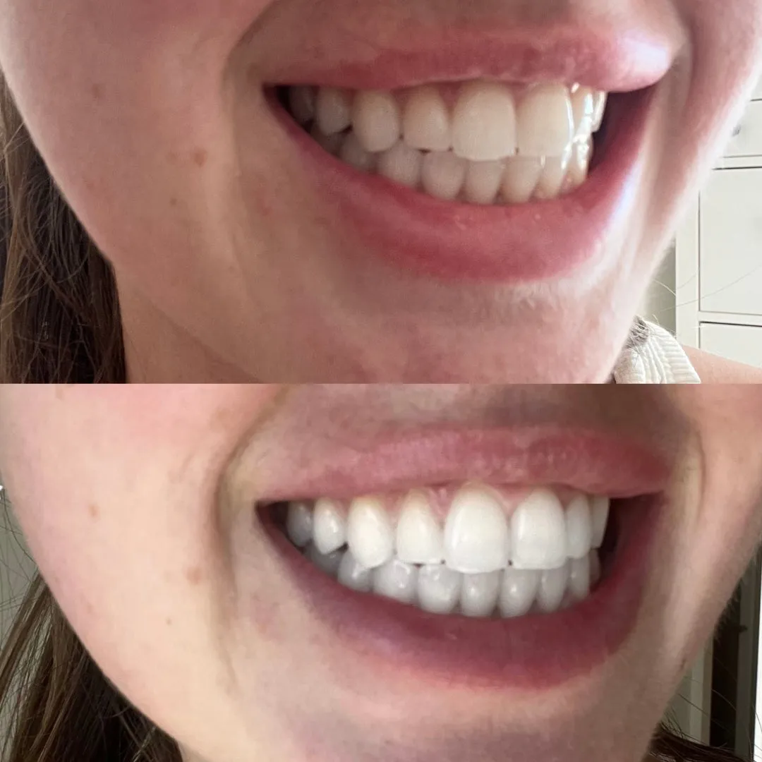 White and Bright Teeth Whitening Bundle